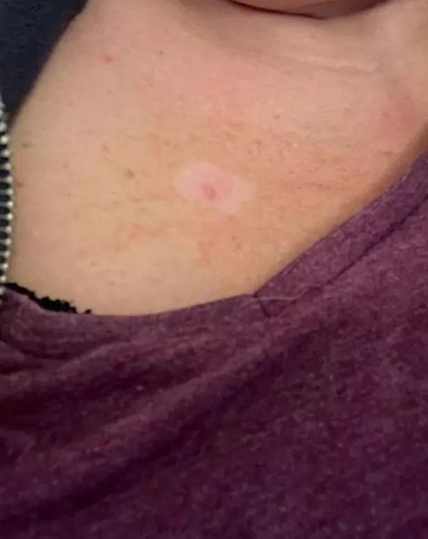 Z początku Rebecca nie przejęła się przebarwieniem