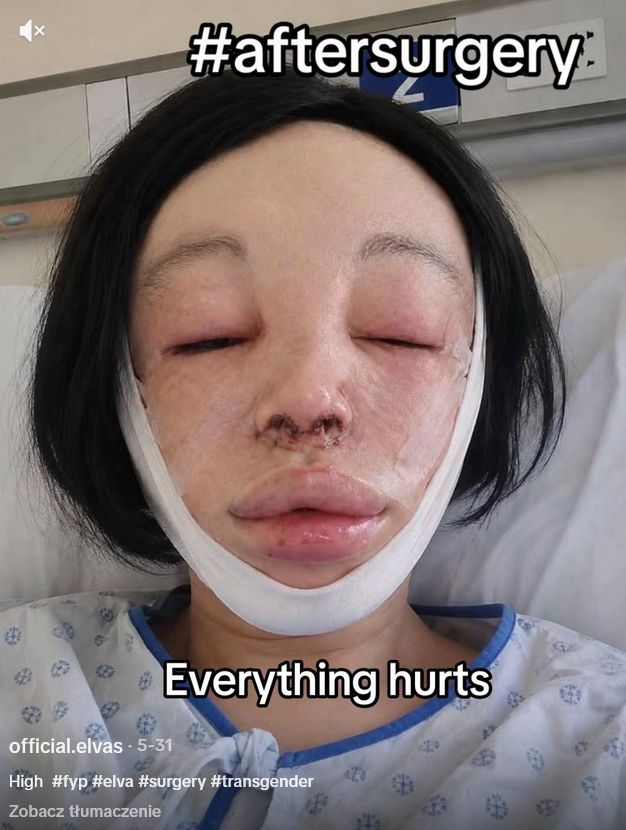 Elva po operacji