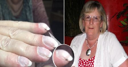 Manicure ocalił 73-latce życie. Zmiany na jej paznokciach były objawem raka płuc