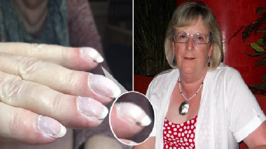 Zmiany na paznokciu objawem nowotworu płuc