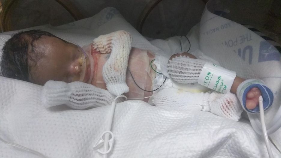 Ja’bari Gray urodził się bez skóry