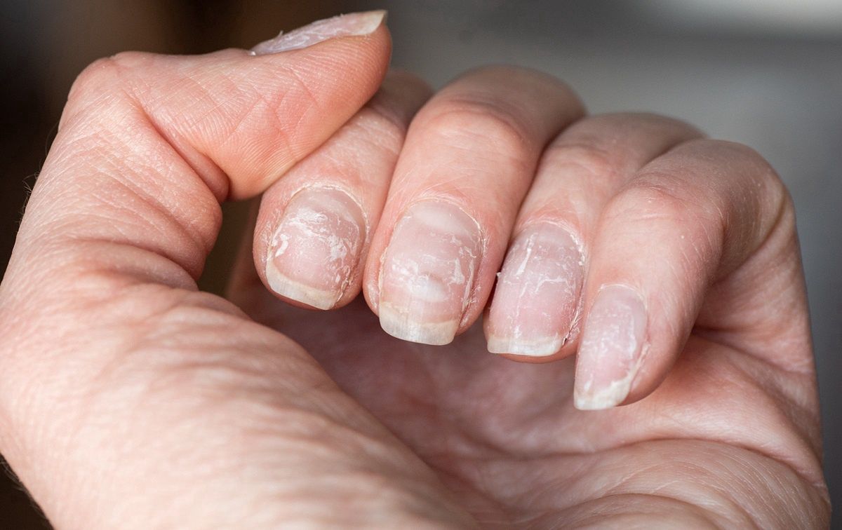 Nail recovery: Affordable methods to restore health