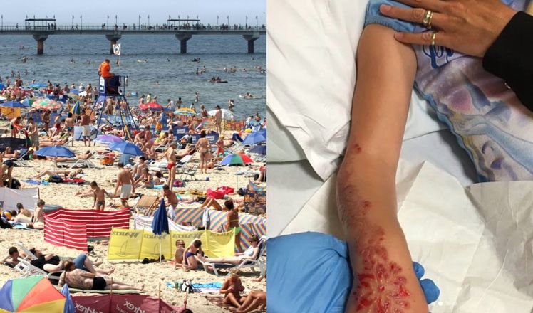 Dziecku spuchła ręka, bo namówiła mamę na tatuaż z henny