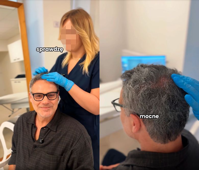 Jan Wieczorkowski przeszedł przeszczep włosów