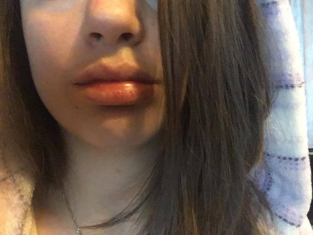 Opuchnięte usta po szczepieniu przeciwko COVID