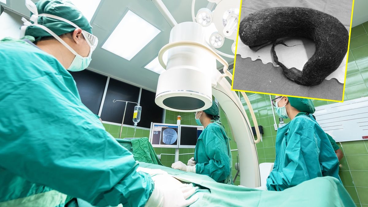 Kobieta miała w żołądku kilogramową bryłę z włosów 