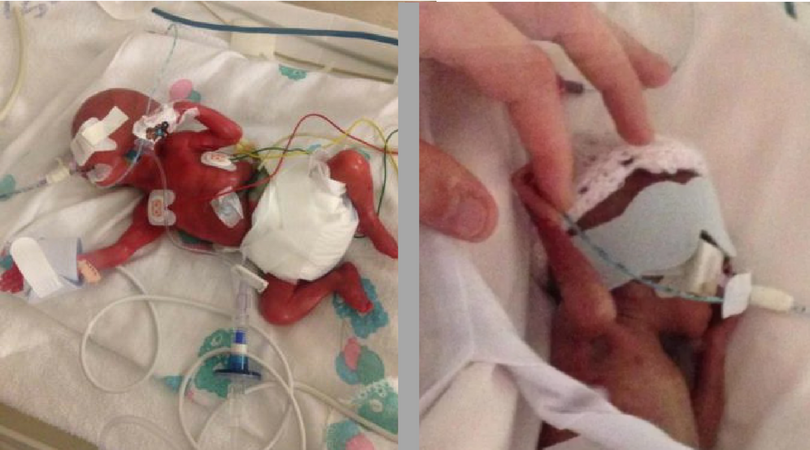 Najmłodsze bliźniaki - przyszły na świat w 23 tygodniu ciąży