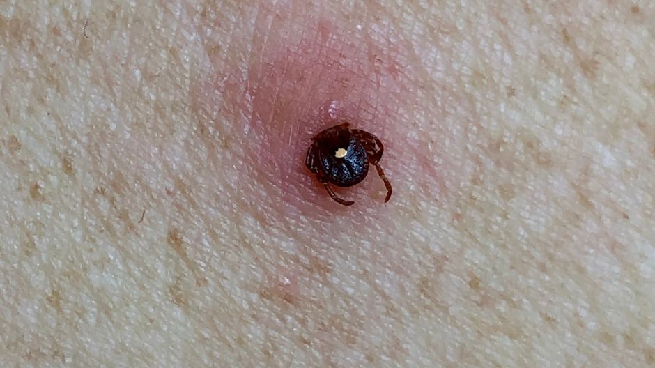 Potwierdzono kolejny śmiertelny przypadek po ukąszeniu. Kleszcz był zakażony wirusem