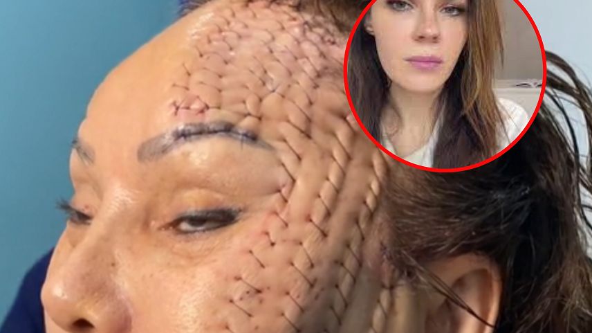 Lifting siatkowy bez skalpela. Przed osobliwą procedurą ostrzegają eksperci