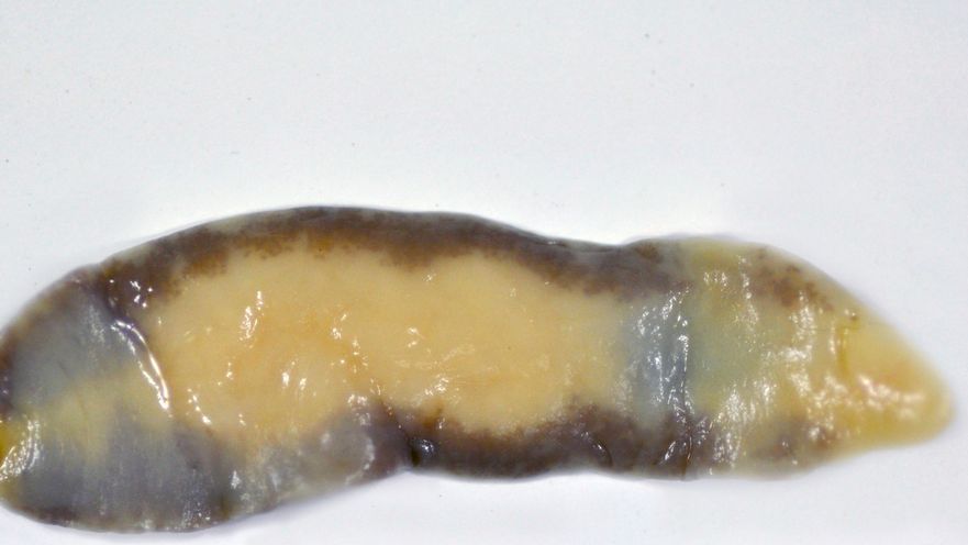 Fasciolopsis buski to największa przywra spotykana u człowieka. Pasożyt wywołuje chorobę o nazwie fasciolopsoza. 