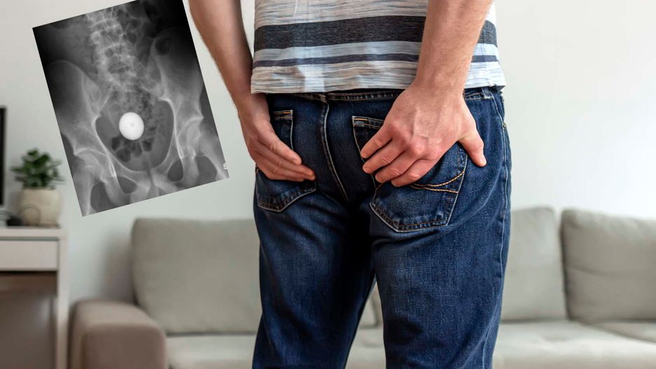 Trafił do szpitala z piłką w jelicie. Sam ją zaaplikował