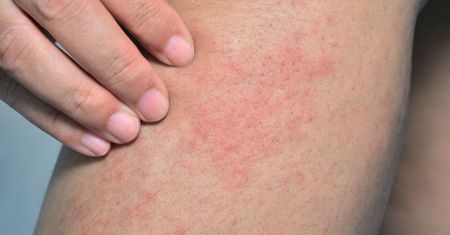Swędzenie skóry – co może oznaczać? Jak łagodzić nieprzyjemny świąd?