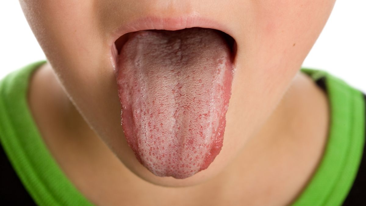 Żółty nalot na języku może być związany z refluksem dwunastnico- żołądkowym.