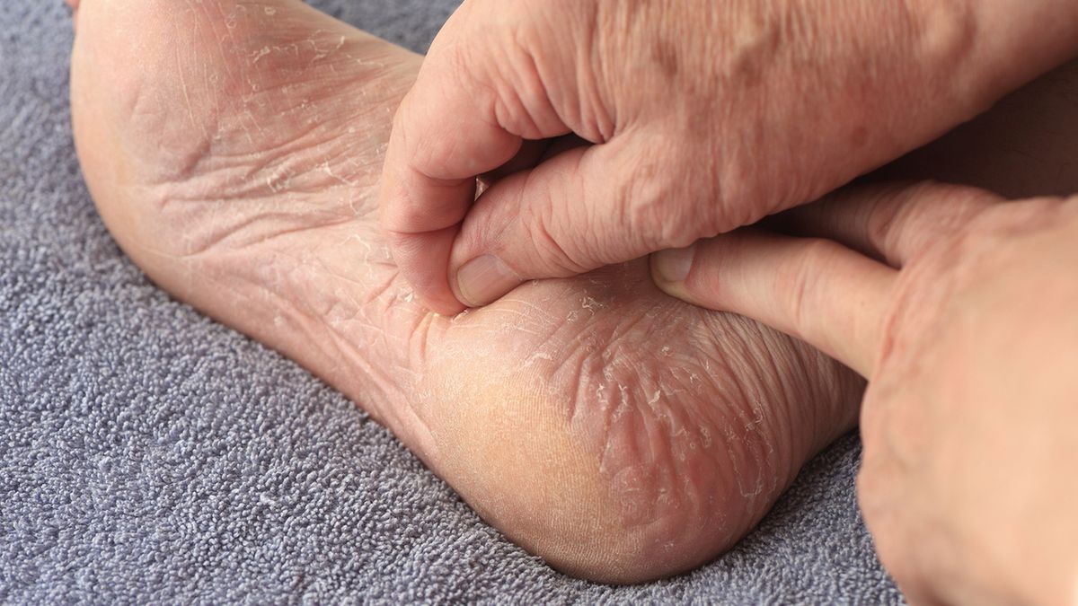 Drożdżyca najczęściej dotyka skóry.