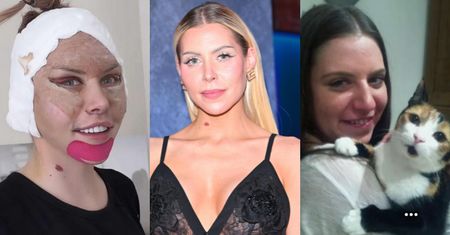 Julia von Stein zafundowała sobie lifting twarzy. Pamiętacie, jak KIEDYŚ wyglądała?
