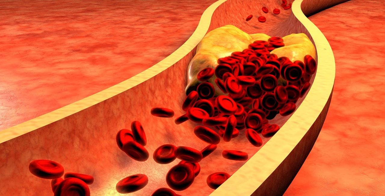 Diagnostyka miażdżycy – objawy, badania laboratoryjne, USG, angiografia, tomografia