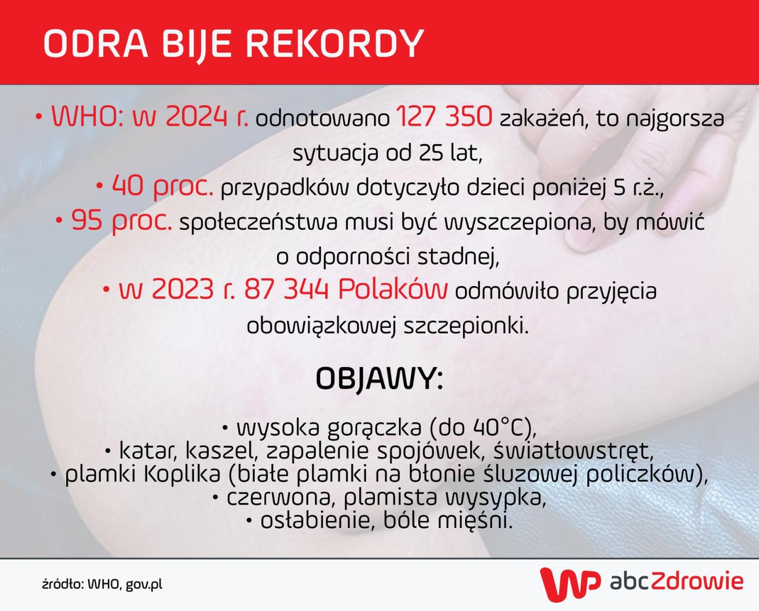 Objawy i statystyki dotyczące odry w Polsce