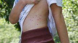 Jeden z najbardziej zauważalnych objawów raka trzustki. Nie ignoruj