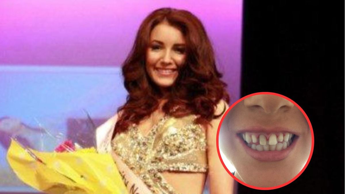 Stomatolog zamontował zamki i druty, aby utrzymać licówki na właściwym miejscu, ale to nie pomogło