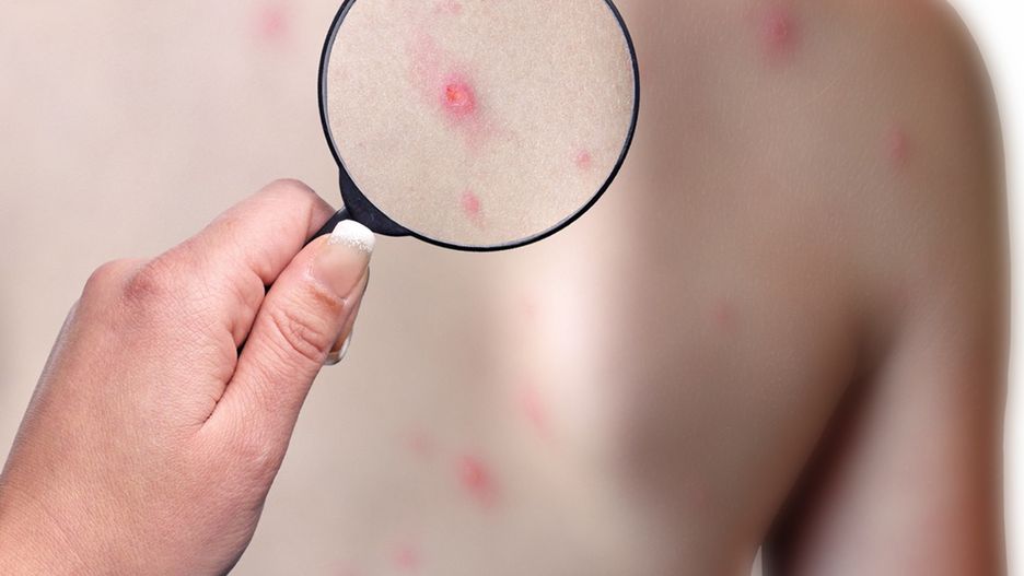 Blizny po ospie mogą być powodem kompleksów i niskiej samooceny