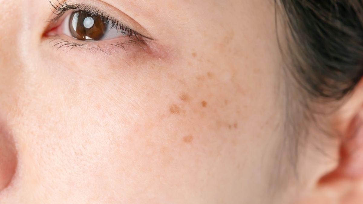 Choroba Recklinghausena to schorzenie pochodzenia nerwowego uwarunkowane genetycznie.