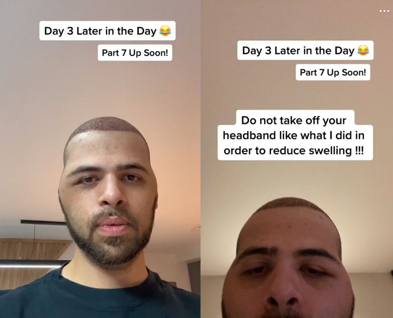 Przeszczepił włosy w Turcji. Oto jego historia