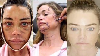 55-letnia Denise Richards zaprosiła kamery na swój LIFTING TWARZY. Spędziła 4,5 godziny na stole operacyjnym (WIDEO)