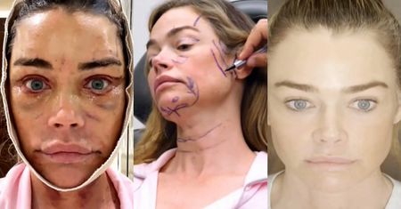 55-letnia Denise Richards zaprosiła kamery na swój LIFTING TWARZY. Spędziła 4,5 godziny na stole operacyjnym (WIDEO)