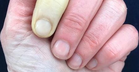 Ma nietypową chorobę. Jej palec czasami przypomina protezę