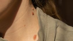 Nie tylko czerniak. Dwa groźne raki skóry atakują znacznie częściej