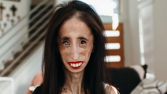 Lizzie Velasquez