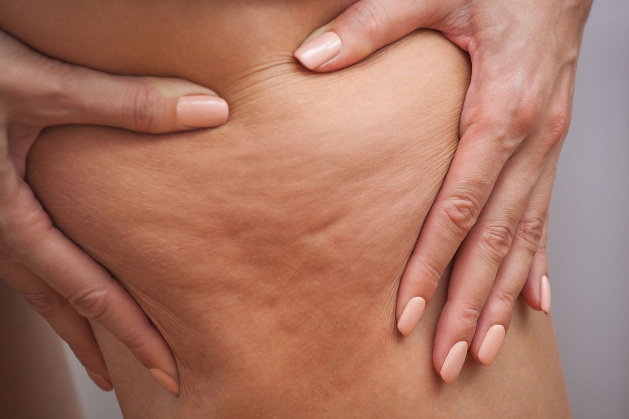 Nowa metoda walki z cellulitem. Wypróbuj "body combing"