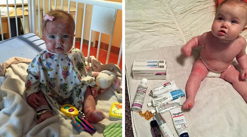 (News Caters Agency) Charlie została zdiagnozowana gdy skończyła 4 miesiące