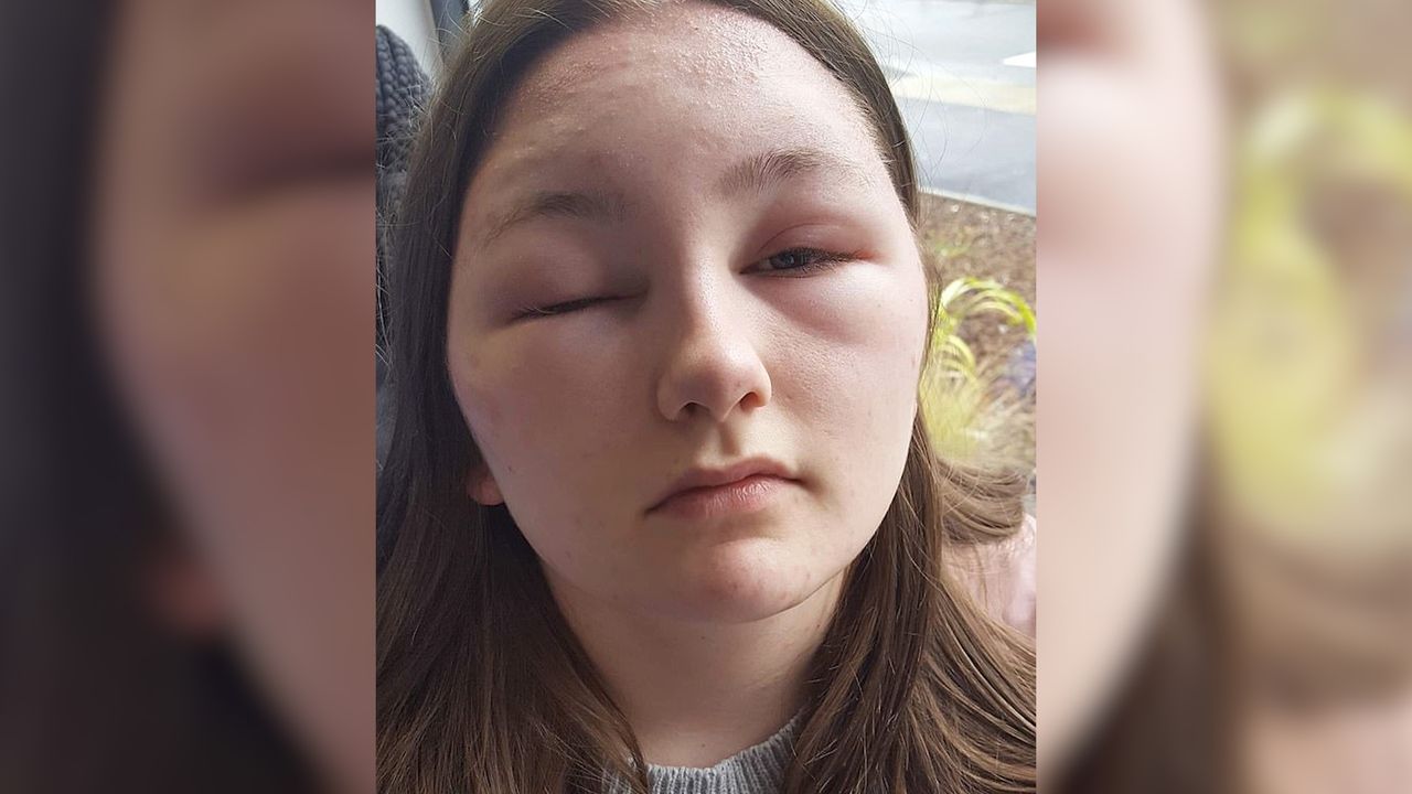 Straciła wzrok na kilka dni. Skutki uboczne farbowania włosów (WIDEO)