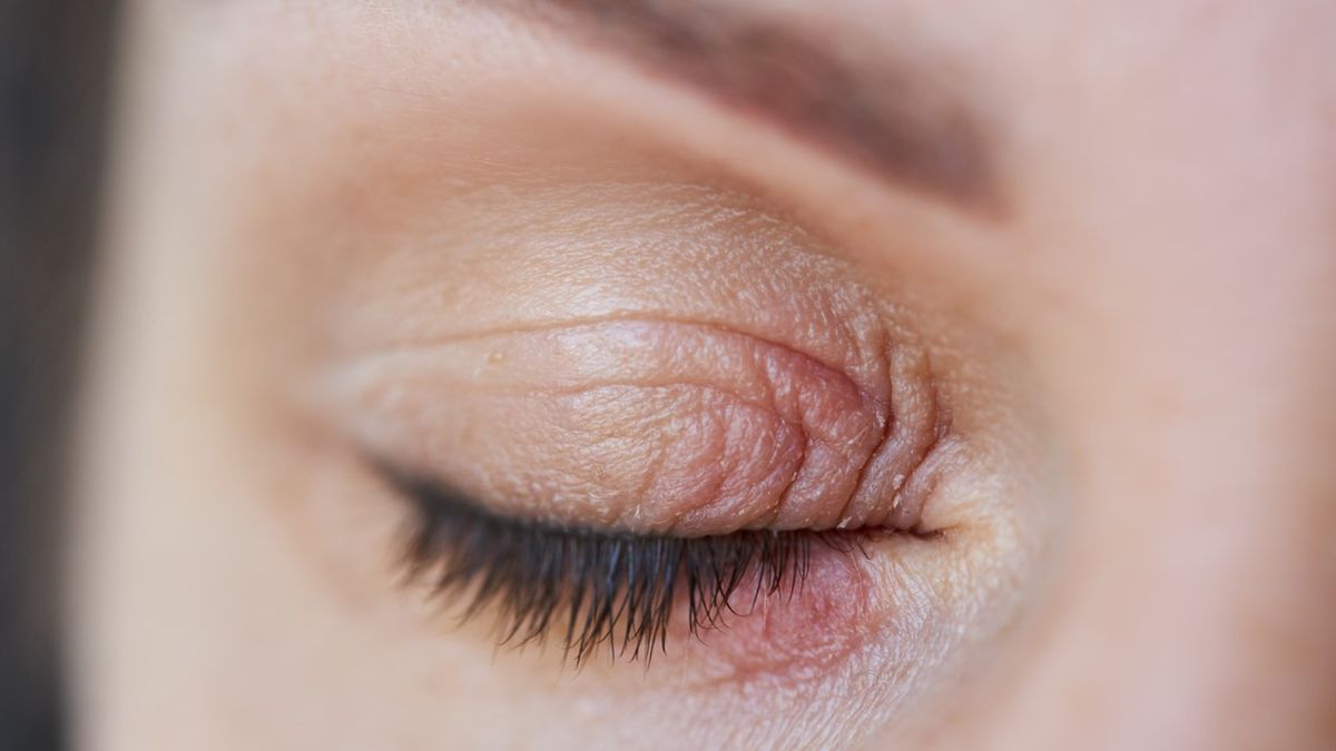 Nużeniec to niewielki pajęczak z rzędu roztoczy, pasożytujący w ludzkich torebkach włosowych oraz gruczołach łojowych.