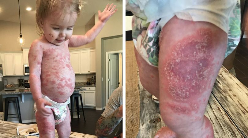 (News Caters Agency) Charlie jest najmłodszą osobą, cierpiącą na zaawansowane stadium łuszczycy