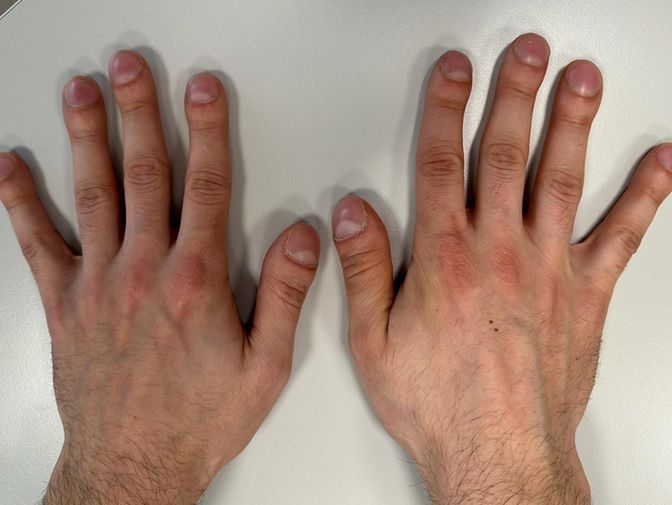 Palce pałeczkowate mogą pojawić się w przypadku różnych schorzeń związanych z zaburzeniami ukrwienia dystalnych części ciała