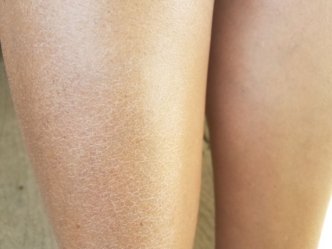 Jak nawilżyć zimą wysuszoną skórę? 