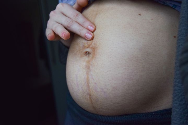 Linea negra znika w ciągu kilku tygodni po porodzie