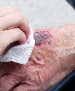 Śląsk. Z odpadu medycznego stała się ratunkiem w leczeniu oparzeń