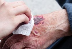 Śląsk. Z odpadu medycznego stała się ratunkiem w leczeniu oparzeń