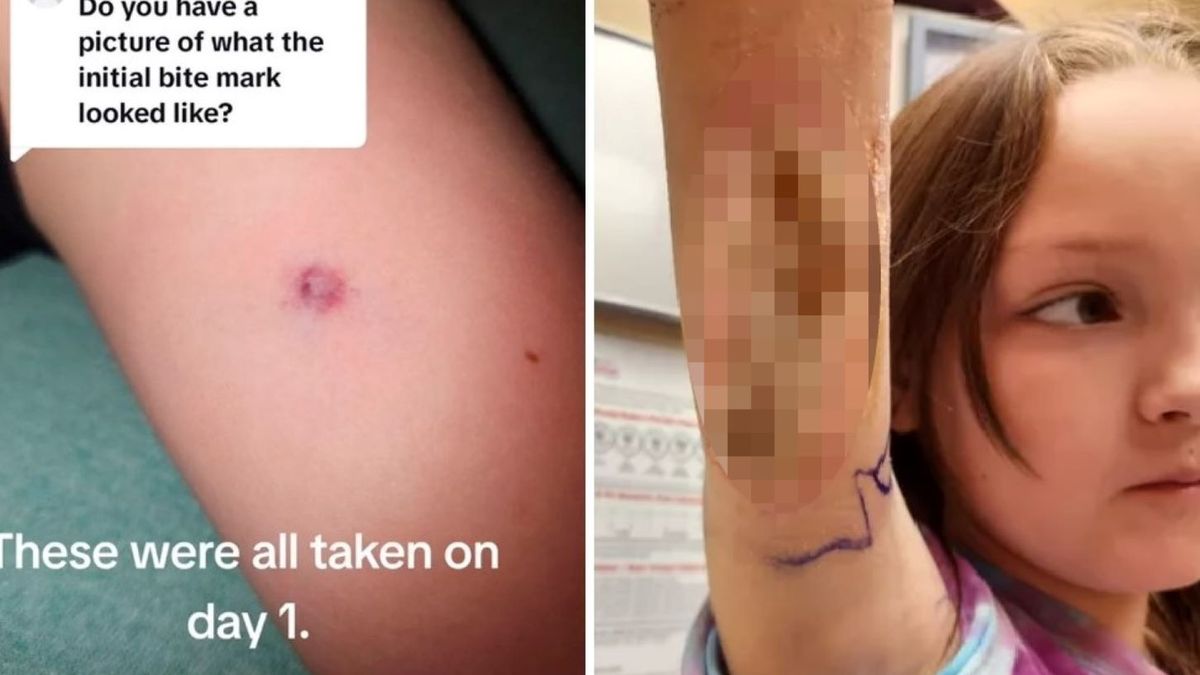 Mała krostka zmieniła się w bolesną ranę 