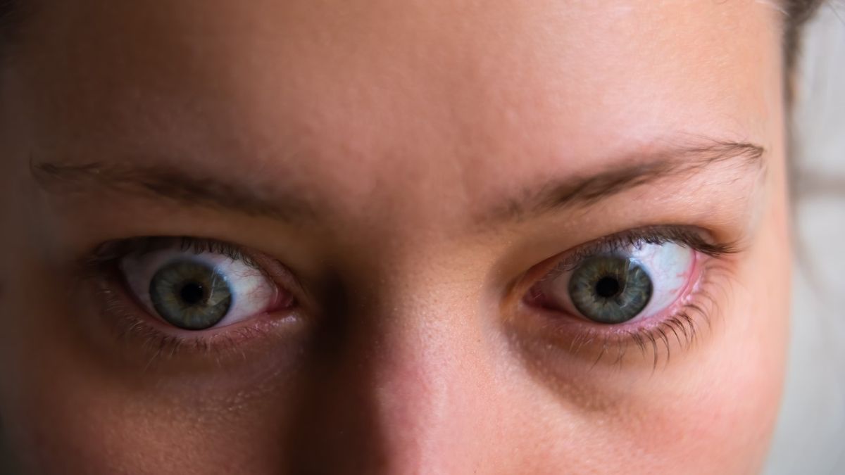 Orbitopatia tarczycowa, czyli wytrzeszcz gałek ocznych, to objaw chorób tarczycy związanych z nadczynnością gruczołu.