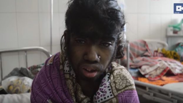 „Syndrom wilkołaka" - to nie tylko mit