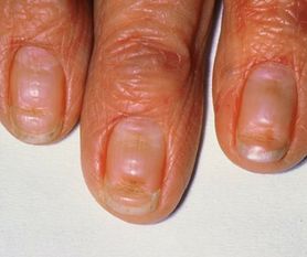 Znak, że cukrzyca już zaatakowała. Charakterystyczny szczegół widać na paznokciach