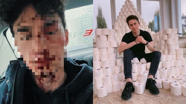 Marcin Dubiel pokazał zakrwawioną twarz