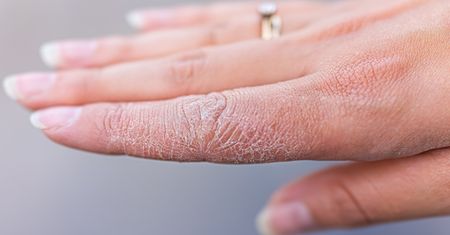 Ratunek dla przesuszonych dłoni. Ten "eliksir" zrobisz w domu