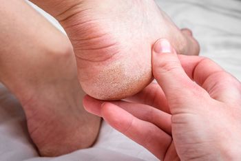 Wmasuj w suche pięty. Stopy będą gładkie jak u niemowlaka