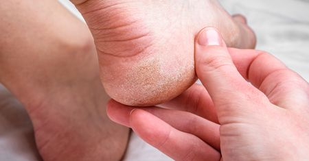 Wsmaruj w suche pięty. Będą gładkie jak u niemowlaka