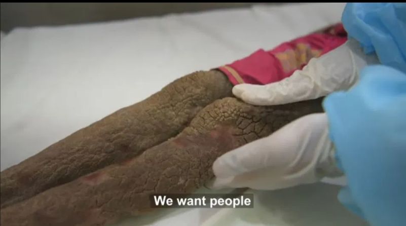 Niestety nie ma terapii, która mogłaby pomóc dziewczynie